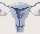 avelumab plus methotrexate in low risk gestational trophoblastic neoplasia