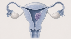 avelumab plus methotrexate in low risk gestational trophoblastic neoplasia