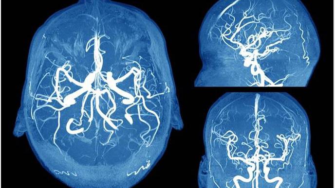 Why Are Women More Likely to Have Brain Aneurysms Compared to Men?
