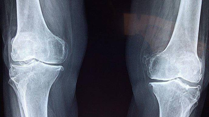 New Technique Cuts Knee MRI Scan Times in Half Without Damaging Diagnostic Certainty