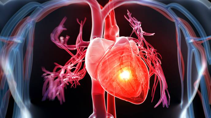 Heart Disease Is World's No. 1 Killer