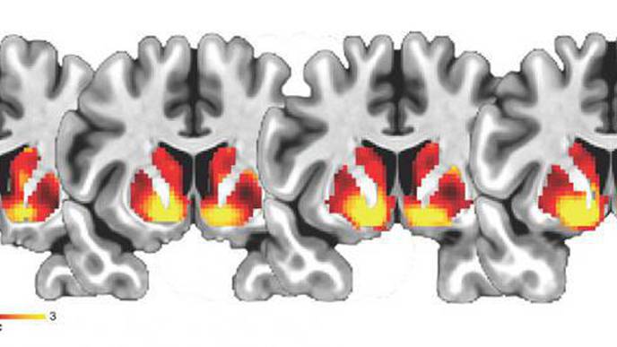 NIH-Funded Study Links Adolescent Brain Differences to Increased Waist Circumference