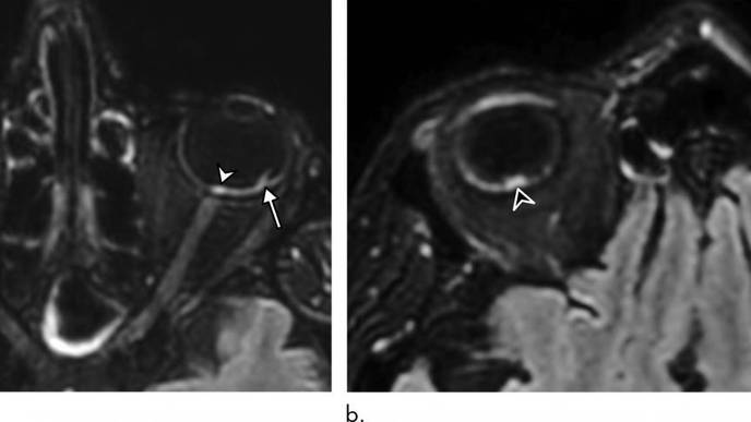 COVID-19 Linked to Potentially Dangerous Eye Abnormalities