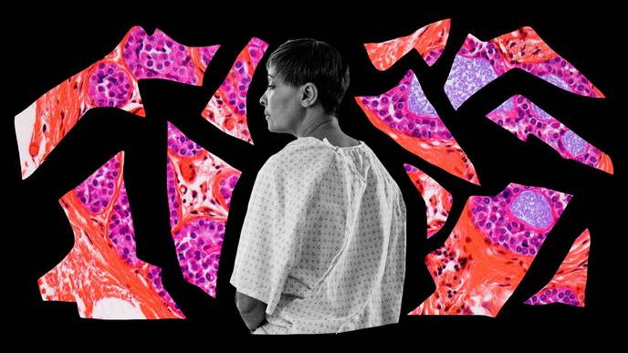 Black Women & Breast Cancer: Where Do The Disparities Lie?