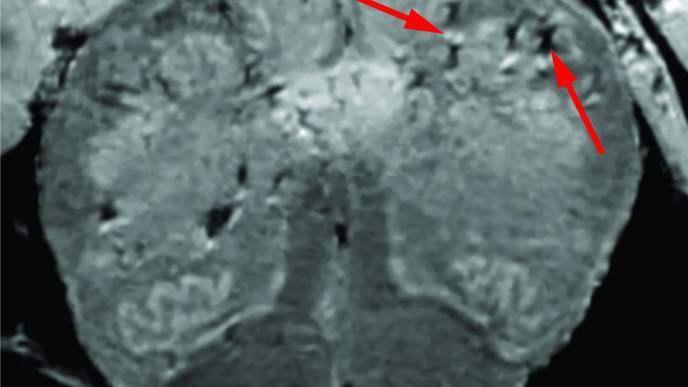 NIH Study Uncovers Blood Vessel Damage & Inflammation in COVID-19 Patients' Brains But No Infection