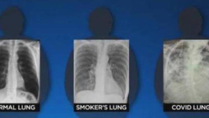 Post-COVID Lungs Worse Than the Worst Smokers' Lungs, Surgeon Says